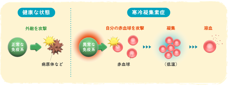 寒冷凝集素症は、どんな病気？イメージイラスト