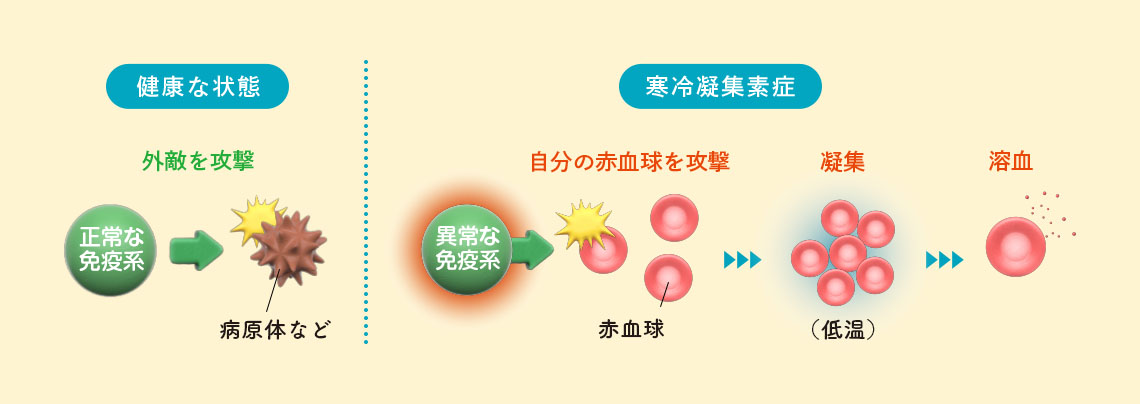 寒冷凝集素症は、どんな病気? イメージイラスト