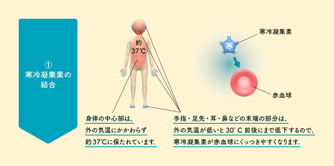 ①寒冷凝集素の結合 イメージイラスト